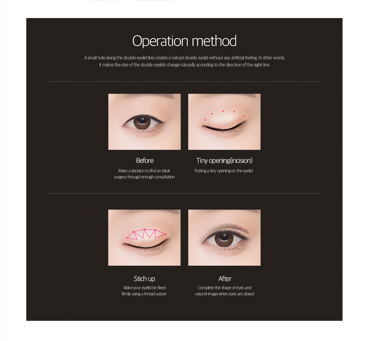 A small hole along the double eyelid line creates a natural double eyelid without any artificial feeling in other words, it makes the size of the double eyelids change naturally according to the direction of the sight line.
