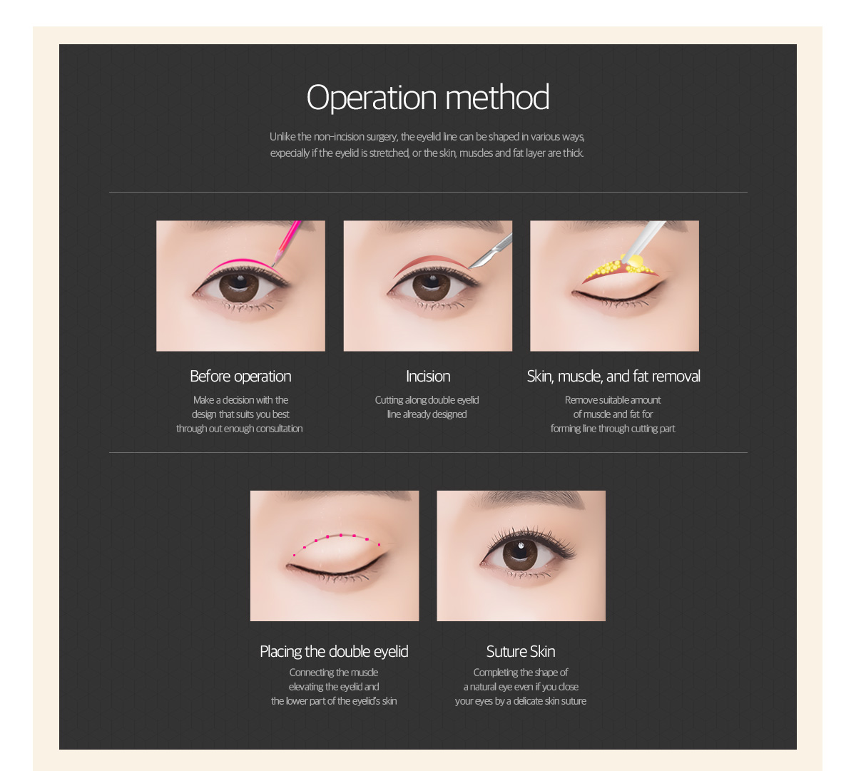 Operation method of Incision Double Eyelid surgery, Incision Technique.
